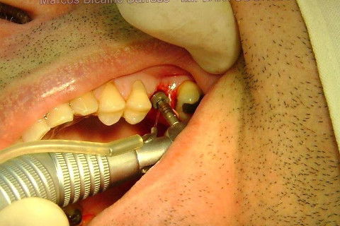 Implante Alvim Cone Morse - Instalação em 20 Minutos, Sem Retalho, Sem Sutura