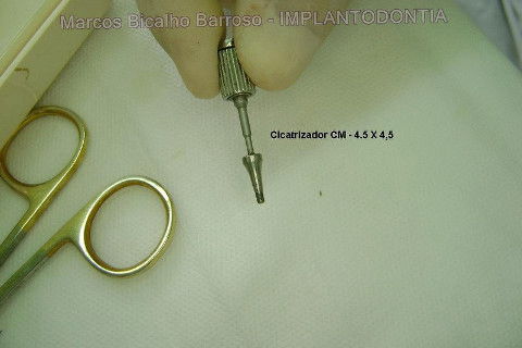 Implante Alvim Cone Morse - Instalação em 20 Minutos, Sem Retalho, Sem Sutura