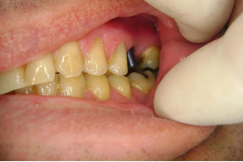 Implante Alvim Cone Morse - Instalação em 20 Minutos, Sem Retalho, Sem Sutura
