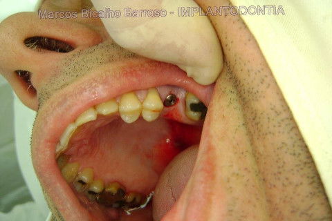 Implante Alvim Cone Morse - Instalação em 20 Minutos, Sem Retalho, Sem Sutura