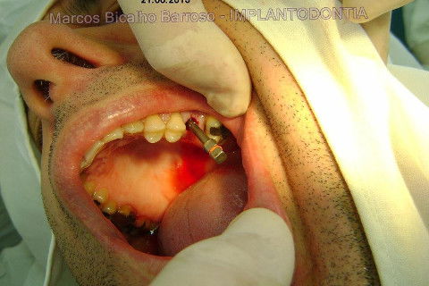 Implante Alvim Cone Morse - Instalação em 20 Minutos, Sem Retalho, Sem Sutura