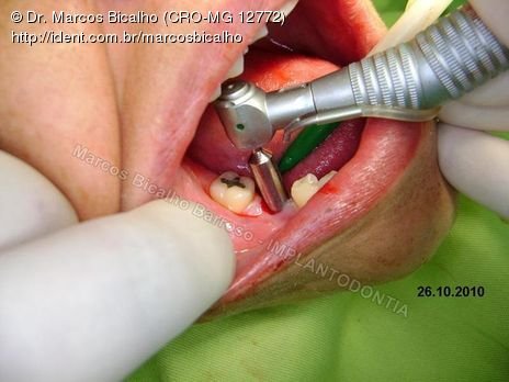 3 Implantes Mandíbula - Variações na Abordagem Cirúrgica (Técnicas para Diérese)