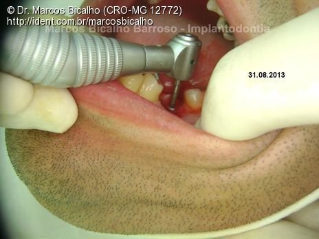 Implante Cone Morse com Cicatrizador Imediato em Região de Molar e Acesso Sem Retalho.