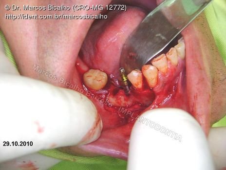 2 Implantes na Mandíbula com Ênfase na Determinação da Posição do Forame Mentoniano - Dentes 45 e 46