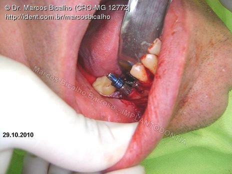 2 Implantes na Mandíbula com Ênfase na Determinação da Posição do Forame Mentoniano - Dentes 45 e 46