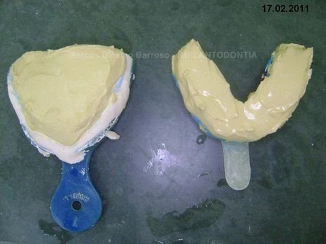 2 Implantes na Mandíbula com Ênfase na Determinação da Posição do Forame Mentoniano - Dentes 45 e 46