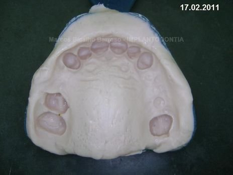 2 Implantes na Mandíbula com Ênfase na Determinação da Posição do Forame Mentoniano - Dentes 45 e 46