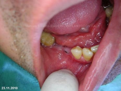 2 Implantes na Mandíbula com Ênfase na Determinação da Posição do Forame Mentoniano - Dentes 45 e 46