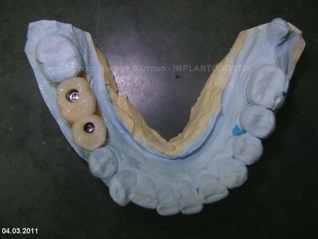 2 Implantes na Mandíbula com Ênfase na Determinação da Posição do Forame Mentoniano - Dentes 45 e 46