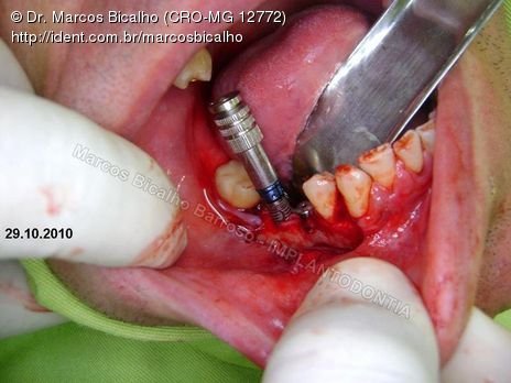 2 Implantes na Mandíbula com Ênfase na Determinação da Posição do Forame Mentoniano - Dentes 45 e 46