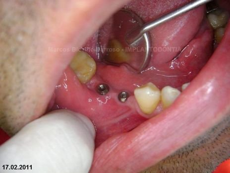 2 Implantes na Mandíbula com Ênfase na Determinação da Posição do Forame Mentoniano - Dentes 45 e 46