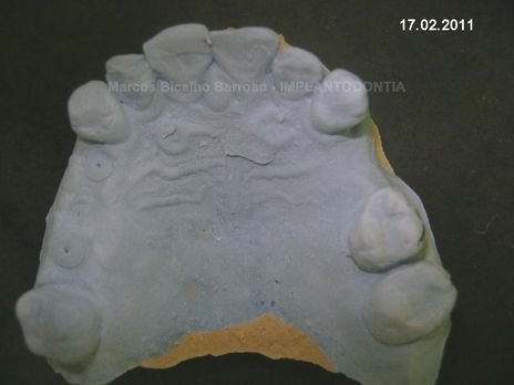 2 Implantes na Mandíbula com Ênfase na Determinação da Posição do Forame Mentoniano - Dentes 45 e 46