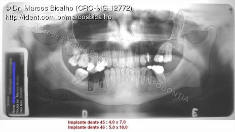 2 Implantes na Mandíbula com Ênfase na Determinação da Posição do Forame Mentoniano - Dentes 45 e 46