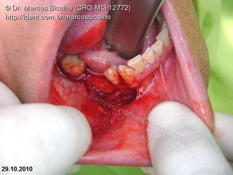 2 Implantes na Mandíbula com Ênfase na Determinação da Posição do Forame Mentoniano - Dentes 45 e 46