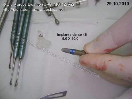 2 Implantes na Mandíbula com Ênfase na Determinação da Posição do Forame Mentoniano - Dentes 45 e 46