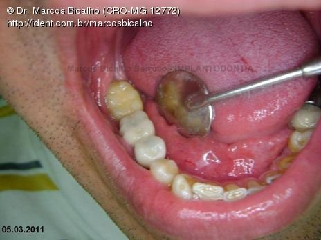 2 Implantes na Mandíbula com Ênfase na Determinação da Posição do Forame Mentoniano - Dentes 45 e 46