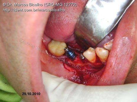 2 Implantes na Mandíbula com Ênfase na Determinação da Posição do Forame Mentoniano - Dentes 45 e 46