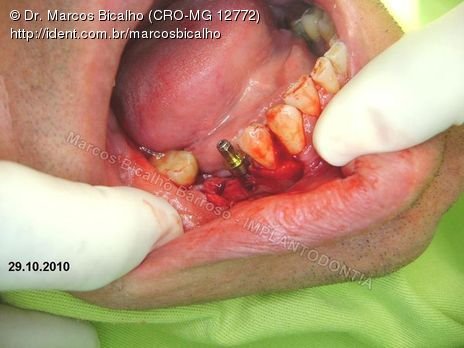 2 Implantes na Mandíbula com Ênfase na Determinação da Posição do Forame Mentoniano - Dentes 45 e 46