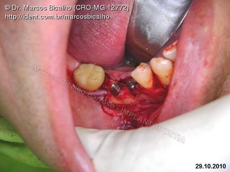 2 Implantes na Mandíbula com Ênfase na Determinação da Posição do Forame Mentoniano - Dentes 45 e 46