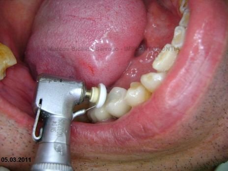 2 Implantes na Mandíbula com Ênfase na Determinação da Posição do Forame Mentoniano - Dentes 45 e 46