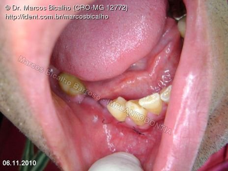 2 Implantes na Mandíbula com Ênfase na Determinação da Posição do Forame Mentoniano - Dentes 45 e 46