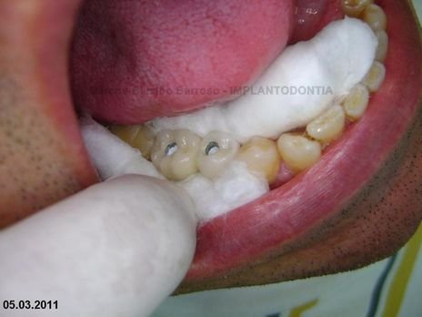 2 Implantes na Mandíbula com Ênfase na Determinação da Posição do Forame Mentoniano - Dentes 45 e 46