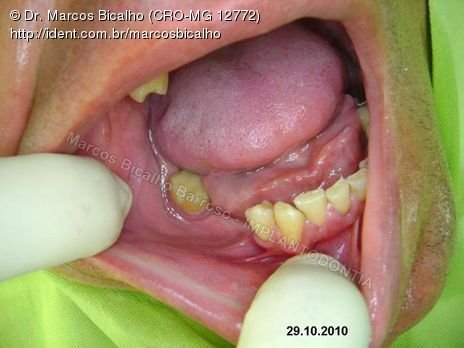 2 Implantes na Mandíbula com Ênfase na Determinação da Posição do Forame Mentoniano - Dentes 45 e 46