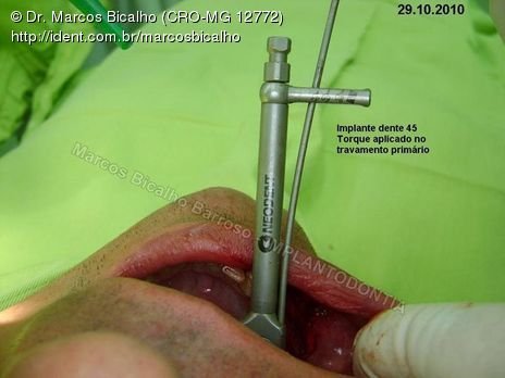 2 Implantes na Mandíbula com Ênfase na Determinação da Posição do Forame Mentoniano - Dentes 45 e 46