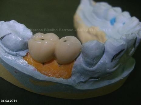 2 Implantes na Mandíbula com Ênfase na Determinação da Posição do Forame Mentoniano - Dentes 45 e 46