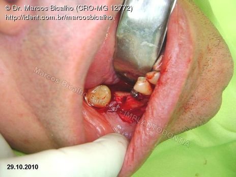 2 Implantes na Mandíbula com Ênfase na Determinação da Posição do Forame Mentoniano - Dentes 45 e 46