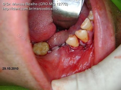 2 Implantes na Mandíbula com Ênfase na Determinação da Posição do Forame Mentoniano - Dentes 45 e 46