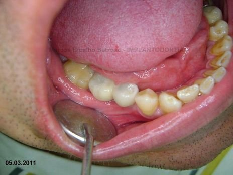 2 Implantes na Mandíbula com Ênfase na Determinação da Posição do Forame Mentoniano - Dentes 45 e 46