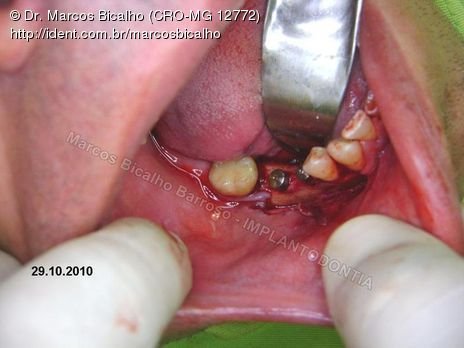 2 Implantes na Mandíbula com Ênfase na Determinação da Posição do Forame Mentoniano - Dentes 45 e 46