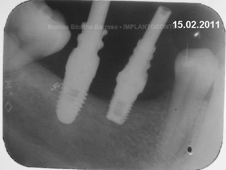 2 Implantes na Mandíbula com Ênfase na Determinação da Posição do Forame Mentoniano - Dentes 45 e 46