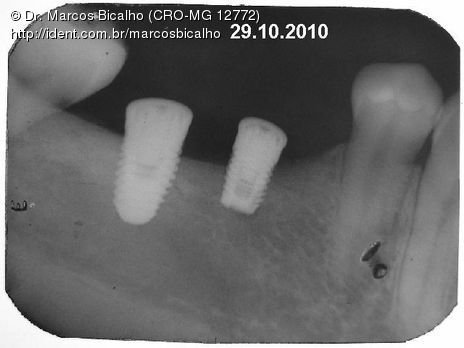 2 Implantes na Mandíbula com Ênfase na Determinação da Posição do Forame Mentoniano - Dentes 45 e 46