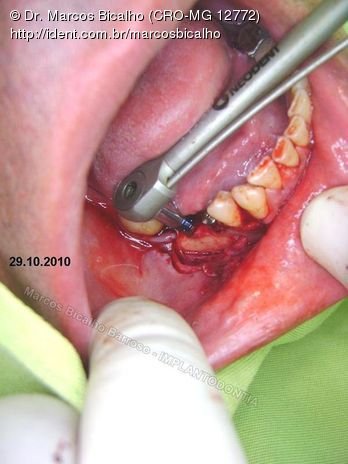 2 Implantes na Mandíbula com Ênfase na Determinação da Posição do Forame Mentoniano - Dentes 45 e 46