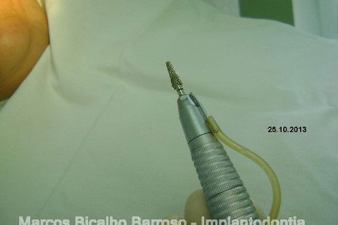 Regeneração Óssea Guiada com Osso Autógeno + Xenógeno + Tela de Titânio