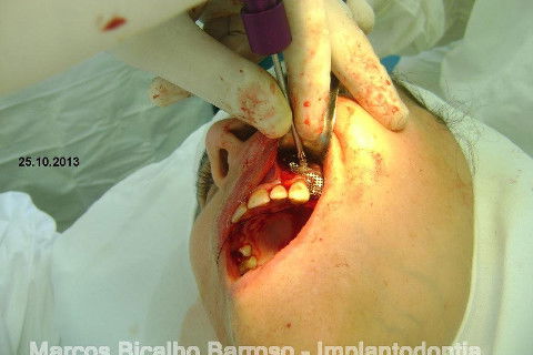 Regeneração Óssea Guiada com Osso Autógeno + Xenógeno + Tela de Titânio