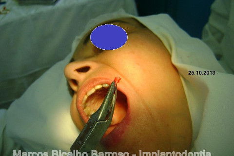 Regeneração Óssea Guiada com Osso Autógeno + Xenógeno + Tela de Titânio