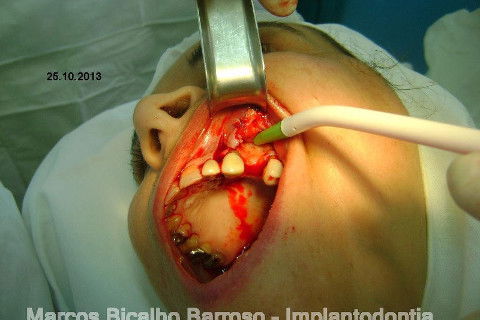 Regeneração Óssea Guiada com Osso Autógeno + Xenógeno + Tela de Titânio