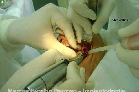 Regeneração Óssea Guiada com Osso Autógeno + Xenógeno + Tela de Titânio