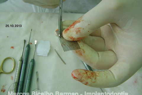 Regeneração Óssea Guiada com Osso Autógeno + Xenógeno + Tela de Titânio