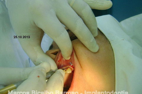 Regeneração Óssea Guiada com Osso Autógeno + Xenógeno + Tela de Titânio