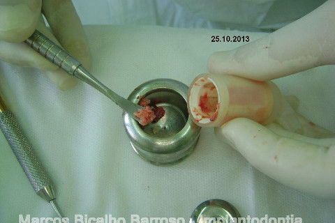 Regeneração Óssea Guiada com Osso Autógeno + Xenógeno + Tela de Titânio