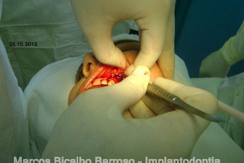 Regeneração Óssea Guiada com Osso Autógeno + Xenógeno + Tela de Titânio