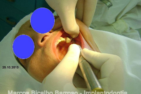 Regeneração Óssea Guiada com Osso Autógeno + Xenógeno + Tela de Titânio