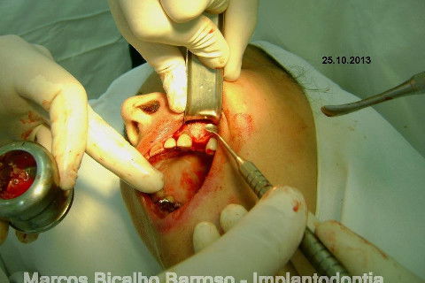 Regeneração Óssea Guiada com Osso Autógeno + Xenógeno + Tela de Titânio