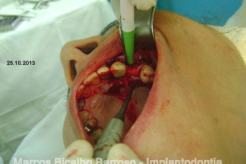 Regeneração Óssea Guiada com Osso Autógeno + Xenógeno + Tela de Titânio