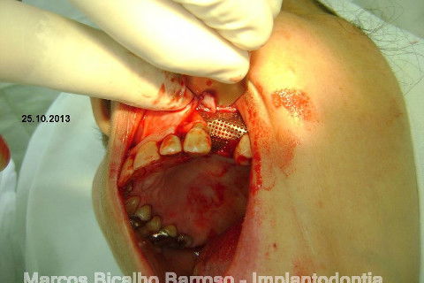 Regeneração Óssea Guiada com Osso Autógeno + Xenógeno + Tela de Titânio