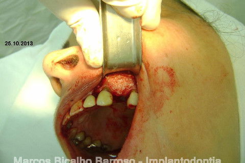 Regeneração Óssea Guiada com Osso Autógeno + Xenógeno + Tela de Titânio